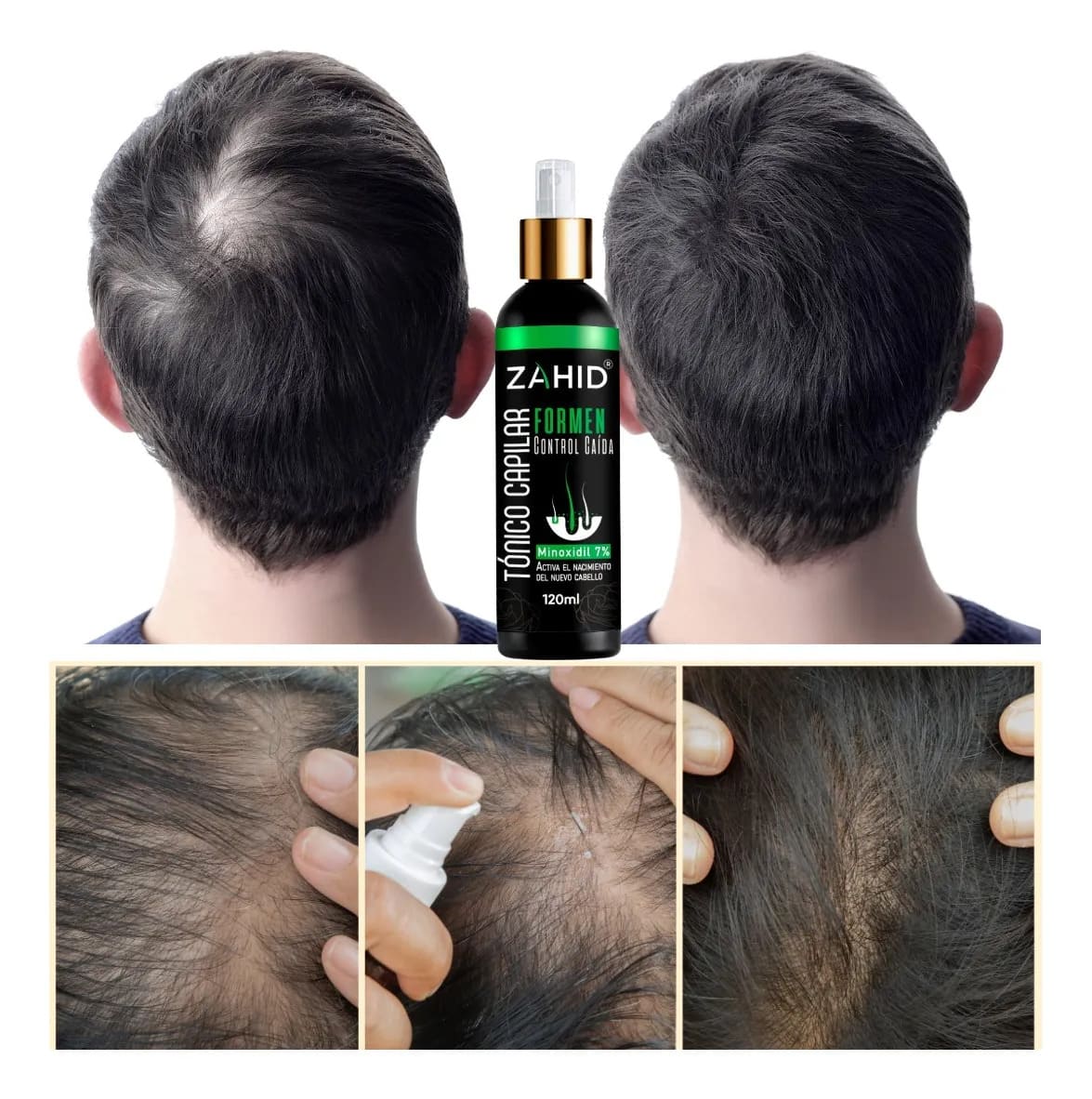 ADIÓS CALVICIE Solución para Crecimiento y Anticaída con (Minoxidil 7%)