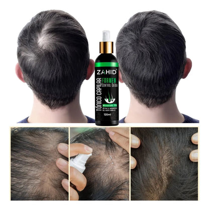 ADIÓS CALVICIE Solución para Crecimiento y Anticaída con (Minoxidil 7%)